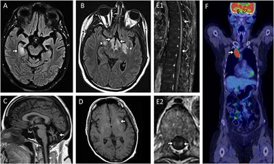 Antibody-Mediated Autoimmune Diseases of the CNS: Challenges and Approaches to Diagnosis and Management